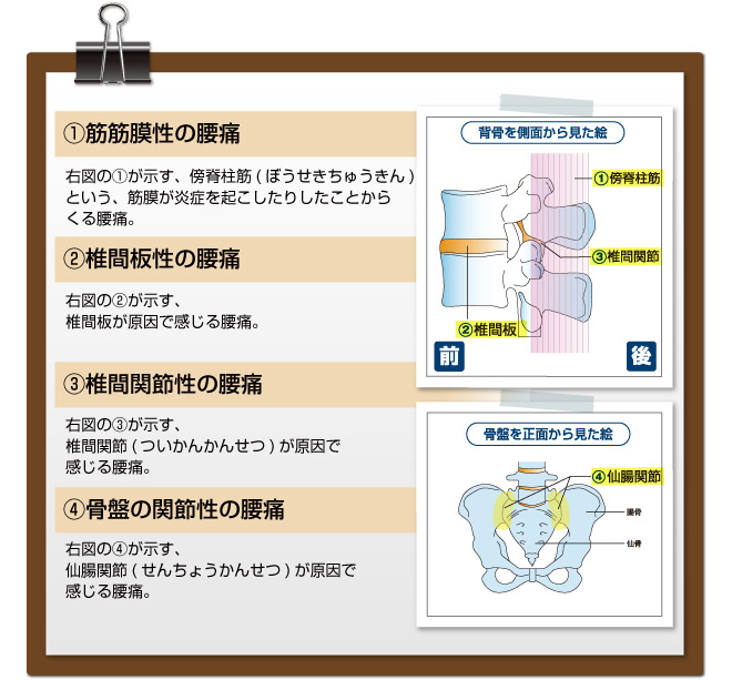 【１筋筋膜性の腰痛】右図の１が示す、傍脊柱筋（ぼうせきちゅうきん）という、筋膜が炎症を起こしたりしたことからくる腰痛。【２椎間板性の腰痛】右図の２が示す、椎間板が原因で感じる腰痛【３椎間間接性の腰痛】右図の３が示す、椎間関節（すいかんかんせつ）が原因で感じる腰痛【４骨盤の間接性の腰痛】右図の４が示す、仙腸関節が原因で感じる腰痛