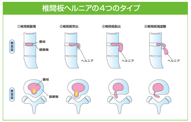 腰痛は手術しなくても改善します。1日3分ラクラク腰痛克服法
