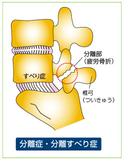 腰痛は手術しなくても改善します。1日3分ラクラク腰痛克服法